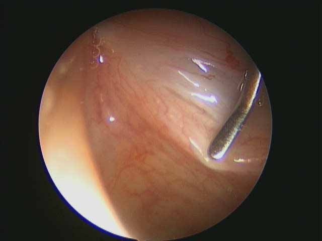  examination with microscope during laryngoscopy   palpation of vocal fold during direct laryngoscopy   palpation of vocal fold during direct laryngoscopy 