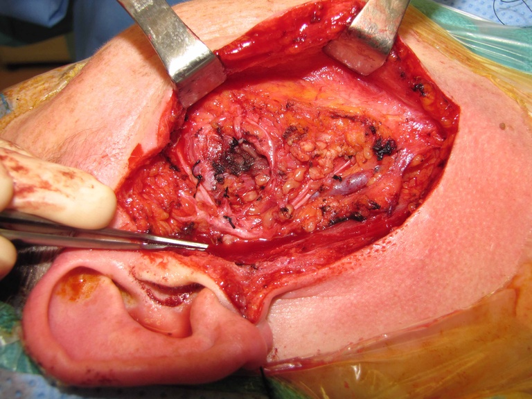 007%20buccal%20br%20resected%20072011.jpg