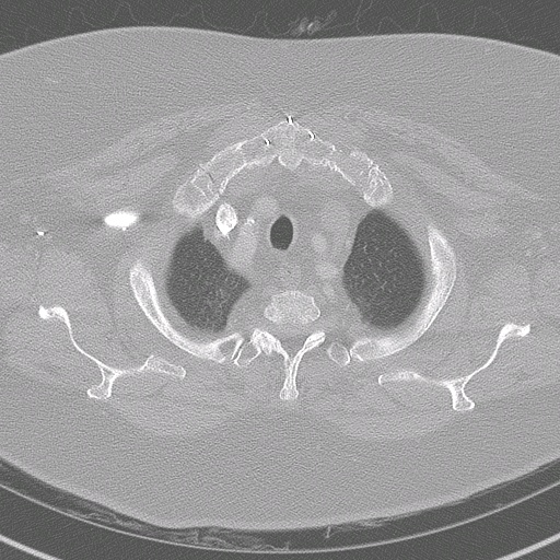 007%20trachstenosis.jpg