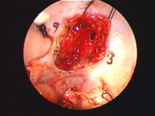 note communication between oral cavity and floor of nose