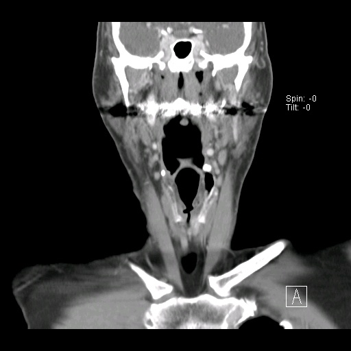 008%20coronal.jpg