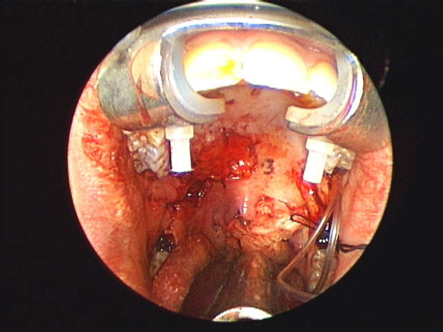 buccal fat flap in place
