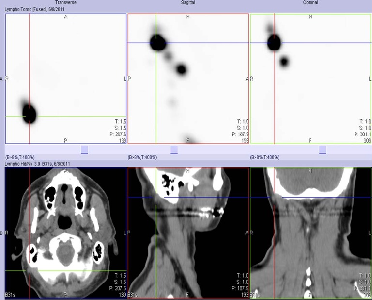 Lymphoscintigram with CT co-registration. Note the post-auricular/anterior occipital node identified within the cross-hairs on the three CT images