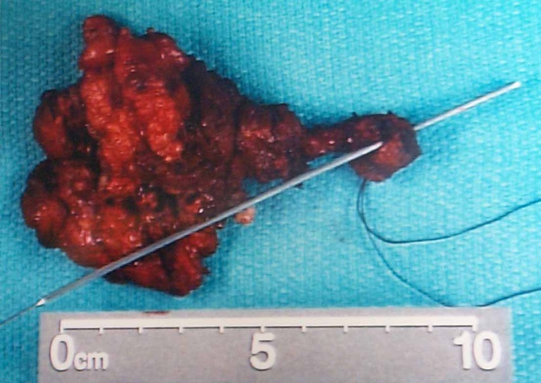 TGD tissue removed at 3rd procedure (2nd revision) showing probe through epithelial lined tract commmunicating with oropharynx