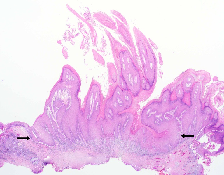 Low power of vocal cord excision showing verrucous squamous carcinoma characterized by long papillae with dense hyperkeratosis and bulbous base (arrows) that invades along a broad front. Examination of the base of the lesion is essential.