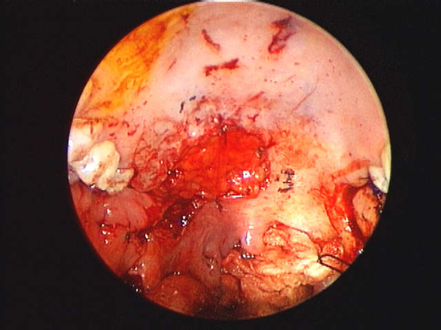 close up of buccal fat flap in place