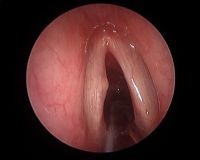 01 intraop before cyst excision.jpg