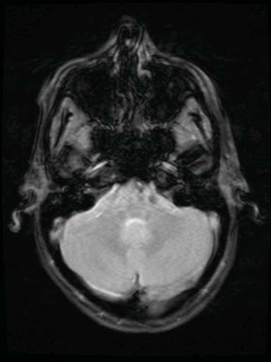 01 mri 122110 left lat medullary infarctb.jpg