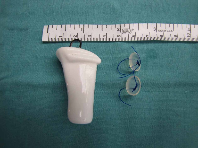 01%20Montgomery%20stent.jpg