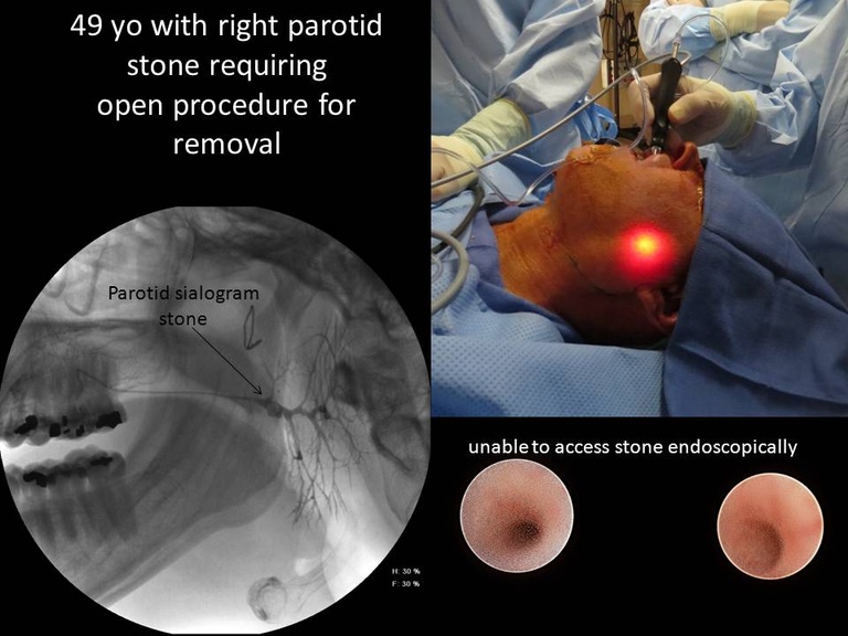 01%20open%20stone%20removal.jpg