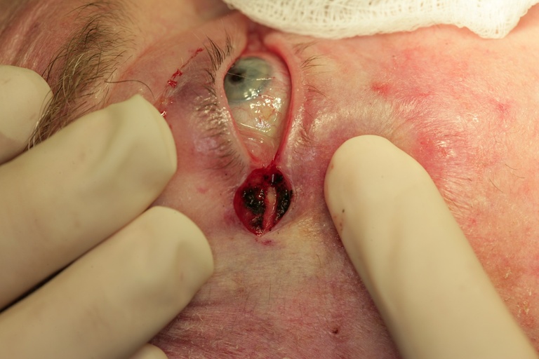 Lateral incision