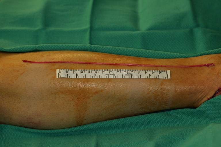 Sural nerve harvested
