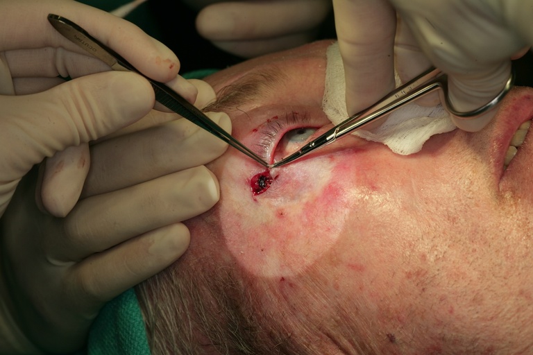 Removing inferior lid gray line