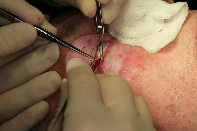 Separating anterior and posterior lamellae