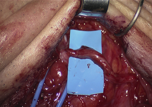 Sural nerve and donor facial nerve branch approximated 