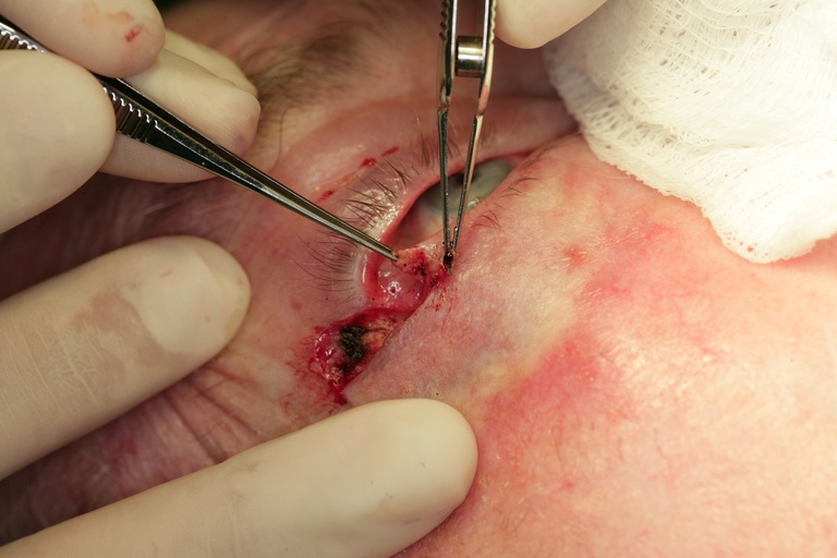 Tarsal plate