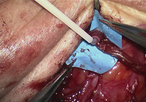 Tisseel glue applied after suture neurorrhaphy 