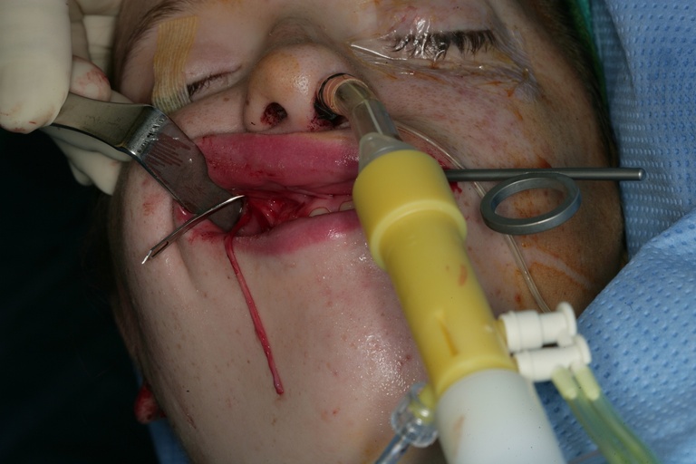 Fascia passer from contralateral to ipsilateral gingivobuccal incision, with sural nerve