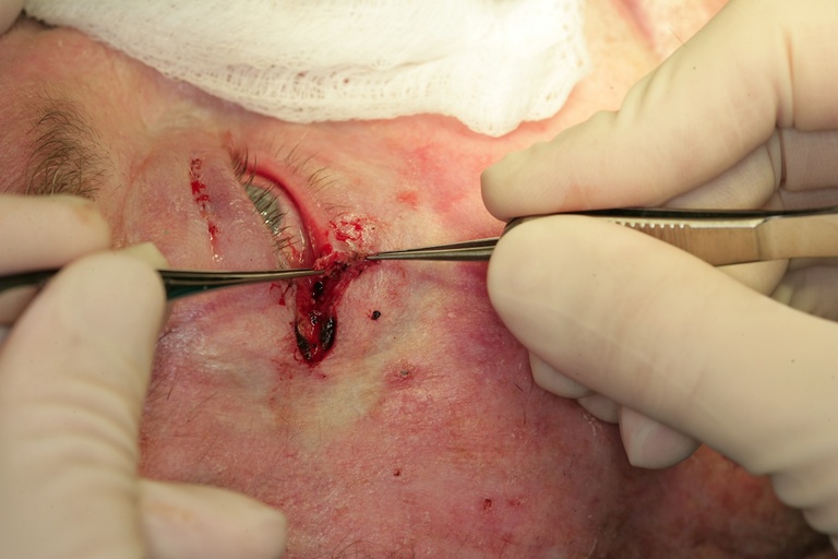 Anterior and Posterrior Lamellae