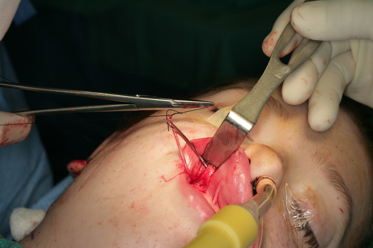 Securing nerve to fascia needle