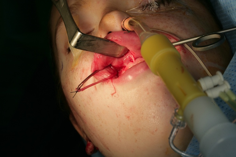Nerve and fascia needle sutured together