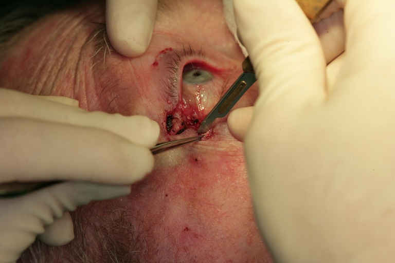 Denuding conjunctiva from tarsal plate