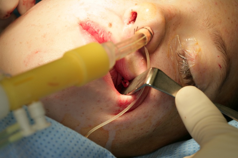    Nerve tip marked with suture in gingivobuccal incision on contralateral (paralyzed) side before placement into pocket 