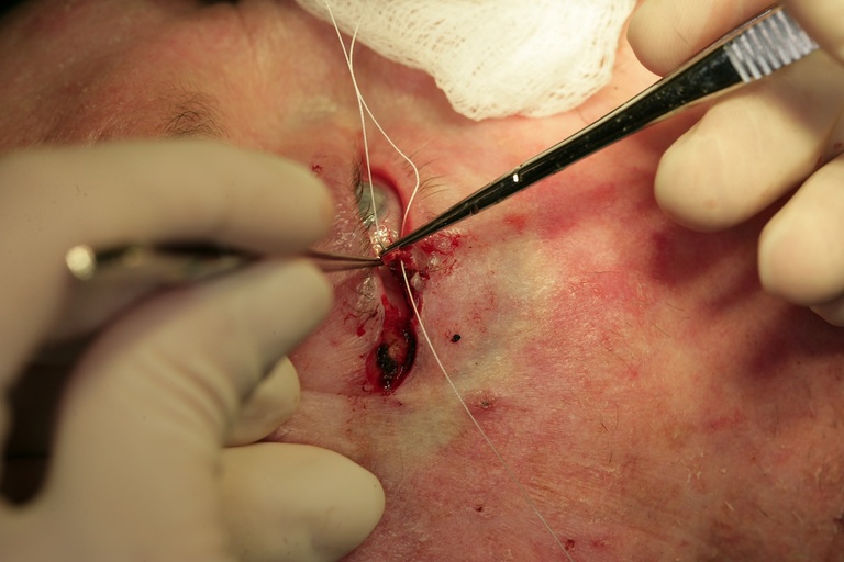 Double armed suture through tarsal plate