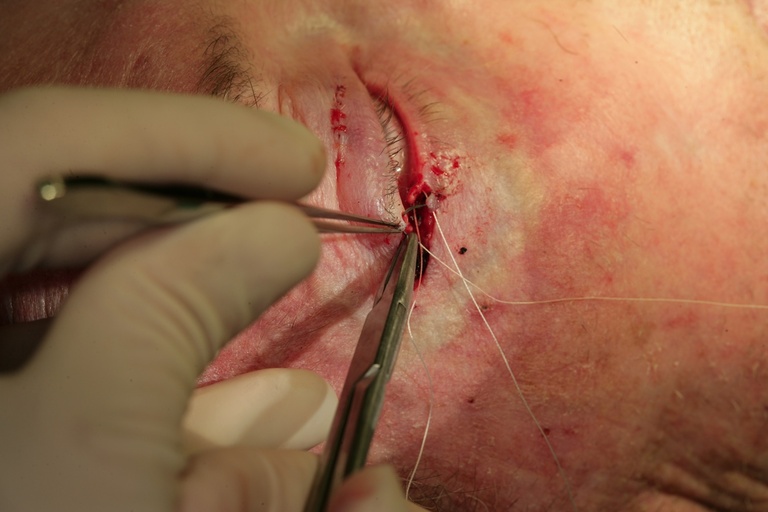 Suture through edge ofupper lid gray line