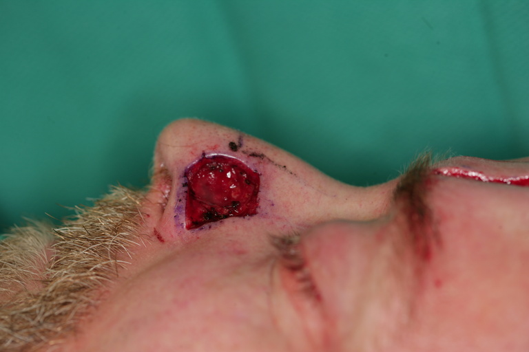 Lateral nasal wall defect