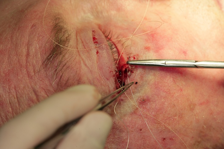Suture through ege of lower lid gray line