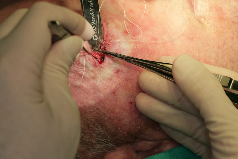 Suspending lower lid to periosteum
