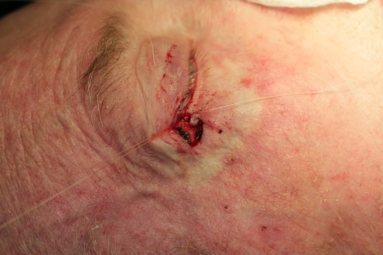 Expected lift of lower eyelid