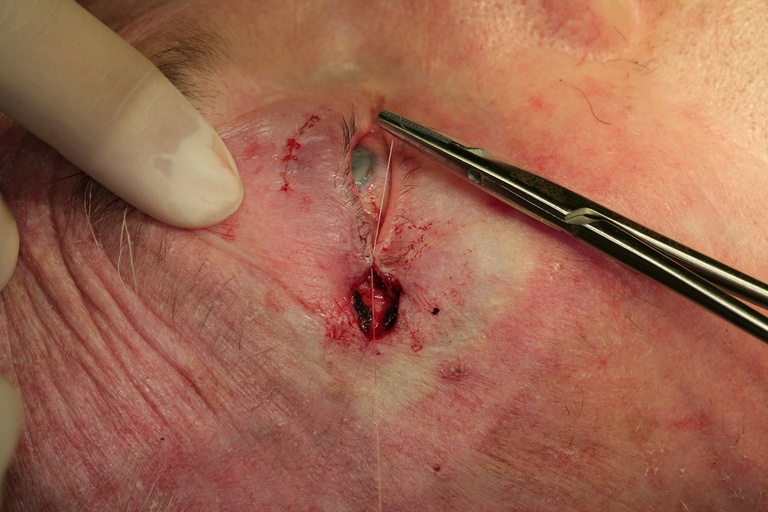 Reestablishing lateral canthal angle