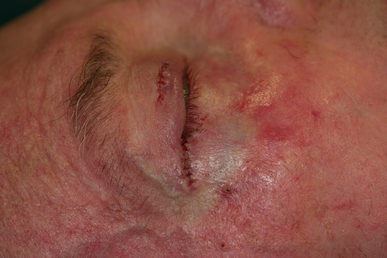 Completed procedure