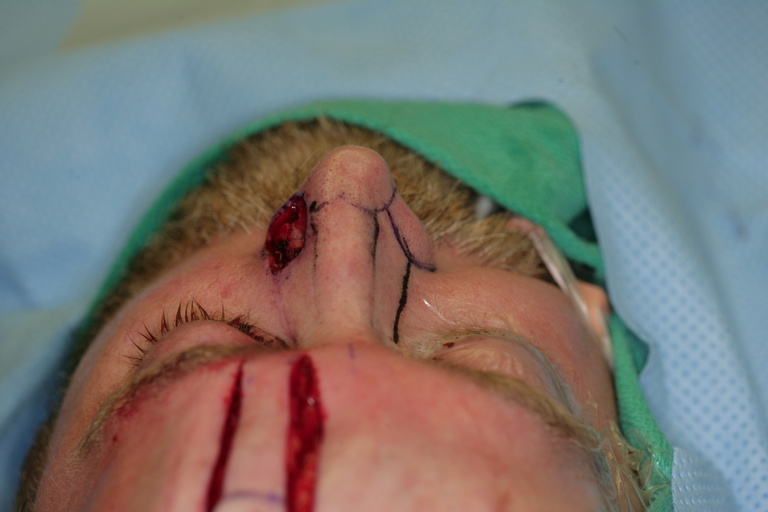   Superior view of defect  