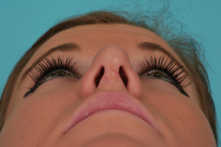 Nasal Base Postop