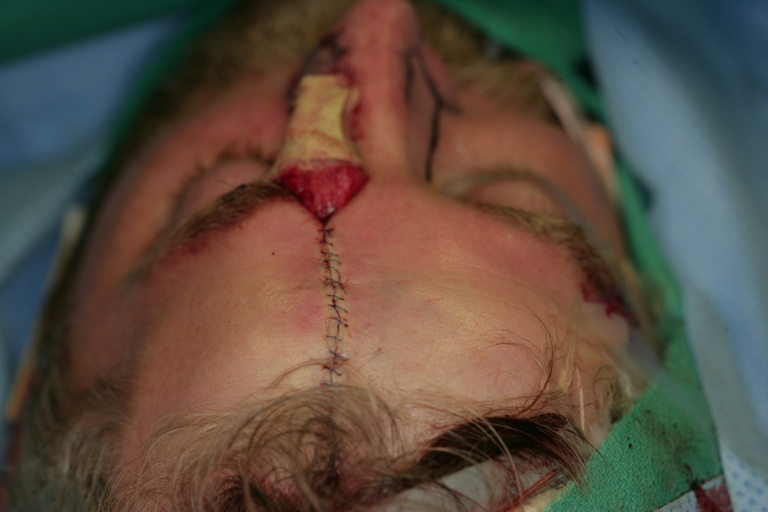   Forehead donor site closed 