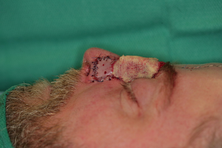   Completed Lateral View (xeroform guaze wrapped around pedicle)  