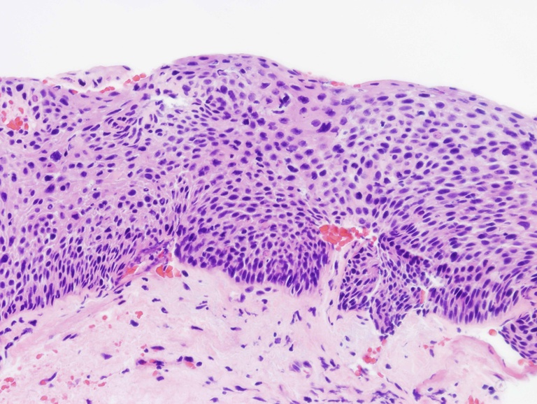 Carcinoma in situ showing full-thickness basal layer expansion. In fact, in this biopsy it is difficult to determine which direction is up and down if the submucosa is ignored.