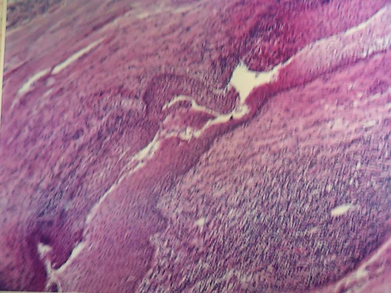 Microscopic view of H+E staining of patent tract communicating from foramen cecum in oropharynx