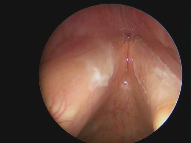 010%20leukoplakia%2008302010.jpg