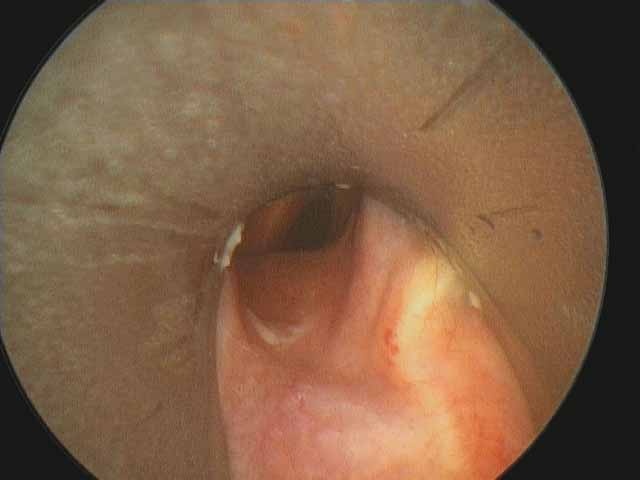 The Dedo laryngoscope is placed into the posterior glottis with the tip separating the posterior membranous vocal cords (jet anesthesia)