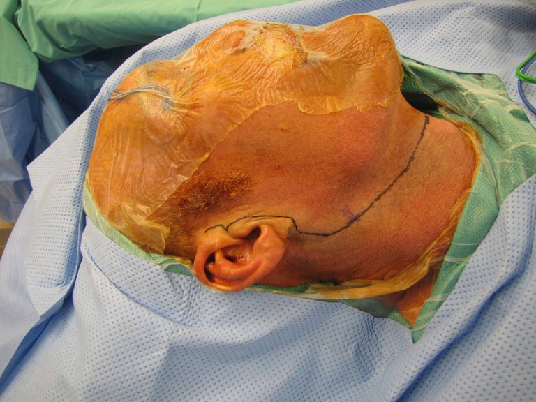 May 23 2011 resection pleomorphic adenoma of parapharyngeal space (deep lobe parotid)