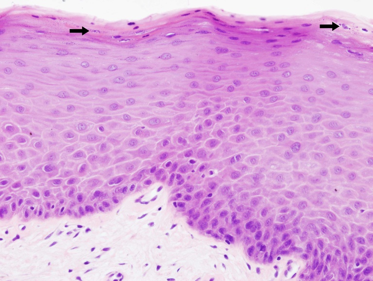 Several keratohyaline granules (arrows) within this parakeratotic mucosa.
