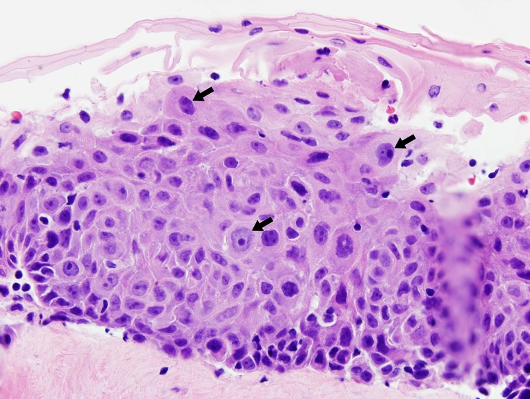 Carcinoma in situ showing profound nuclear atypia (black arrows) with marked architectural disorder. Note that although there is a little surface maturation, the diagnosis is still in situ carcinoma.