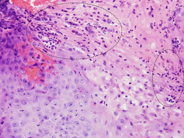 Hyperplastic squamous mucosa containing areas of neutrophilic inflammation (dotted ovals).