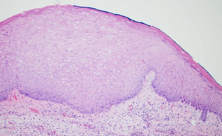 Hyperplastic squamous mucosa showing increased total thickness of the epithelium.