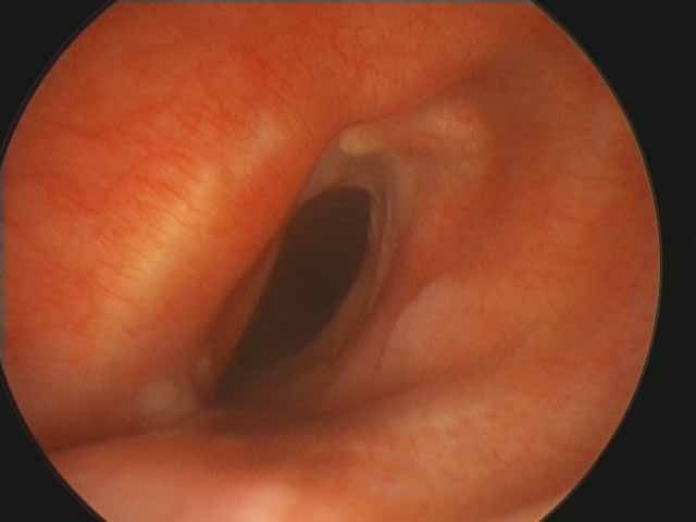 Microdirect laryngoscopy with long 0 degree scope shows scarring anteriorly drawing lateral walls medially