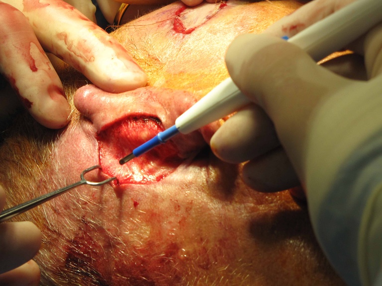 Undermining posteriorly will allow the soft tissue to advance with 3-0 nylon 'half-buried mattress' sutures